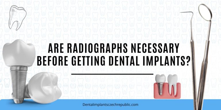 Are radiographs necessary before getting dental implants