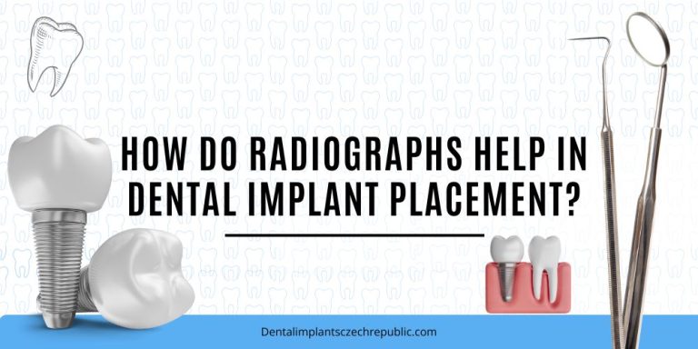 How do radiographs help in dental implant placement