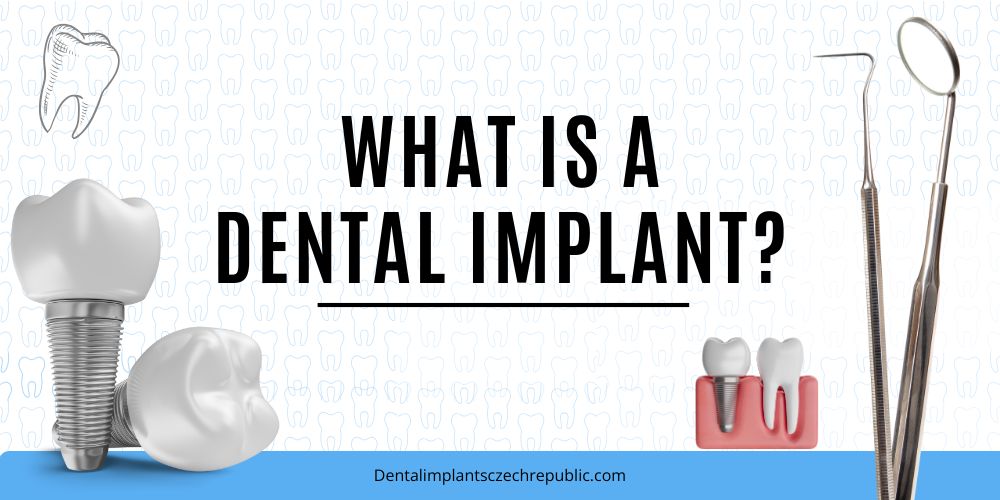 What Is A Dental Implants